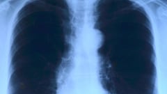 Científicos resuelven una de las causas del cáncer de pulmón más comunes y no tiene nada que ver con el tabaco