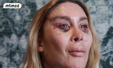 ‘La Pelopony’ muestra su rostro tras sus seis operaciones estéticas en Turquía