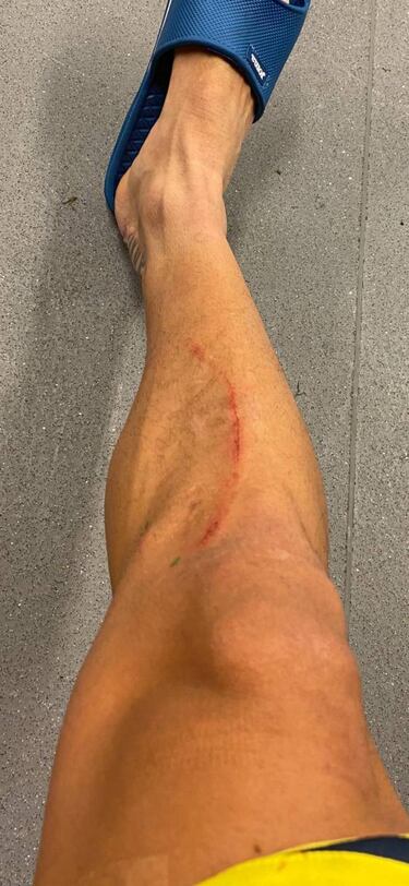 Así quedó la pierna de Cazorla