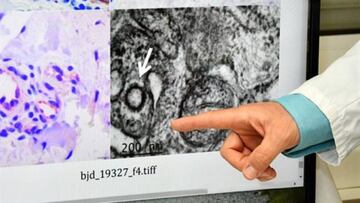 El coronavirus, presente en lesiones de la piel en pacientes con PCR negativo