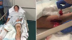 Graves heridas de Matteo Jorgenson tras su accidente en Roubaix.