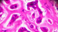 Muestra patológica cutis de la lepra de los lepromatosa bajo microscopia ligera
SALUD
JXFZSY/ ISTOCK