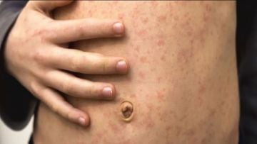 Viruela del Mono 2022: Síntomas, medidas preventivas y qué hacer si se detecta un contagio