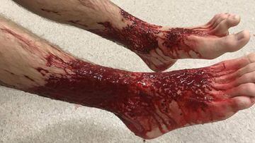 Las piernas de Sam Kanizay al llegar al hospital tras sufrir el ataque