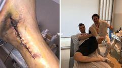 Las imágenes del pie de Fonsi Nieto tras su última operación