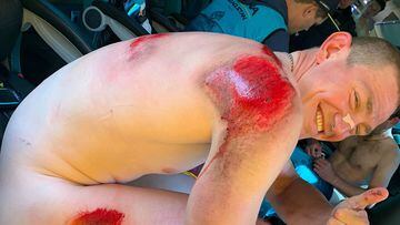 El ciclista ruso Gleb Syritsa muestra sus heridas tras la dura caída que sufrió en la primera etapa de los Cuatro Días de Dunkerque.