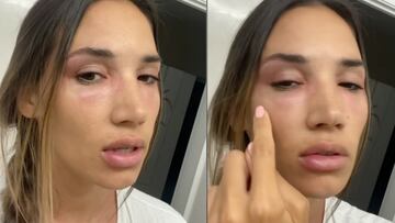 India Martínez preocupa al mostrar su rostro desfigurado: “Ni el móvil me reconoce”
