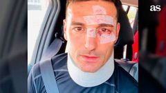 Scaloni&#039;s injuries after being run over.