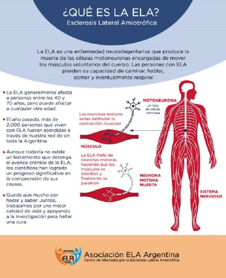 Qué Es La Esclerosis Lateral Amiotrófica Ela Y Cuáles Son Sus Primeros Síntomas As Argentina