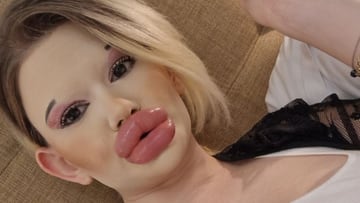 30 inyecciones en los labios para convertirse en la ‘Barbie’ humana