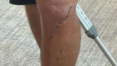 Grapas y cicatriz tras una operaci&oacute;n de tibia en la rodilla del rider de MTB Cam McCaul.