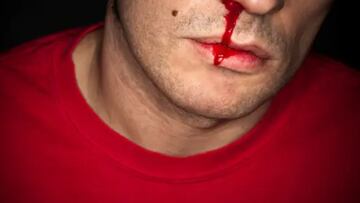 Alerta si tienes este tipo de sangrado de nariz