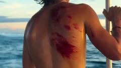 El surfista Max Beach con heridas en la espalda en las Fiji.