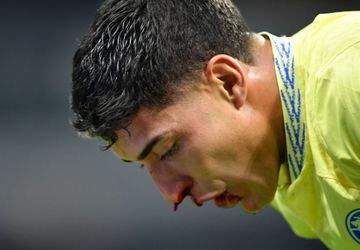 The midfielder suffered a broken nose in América's win over Monterrey.