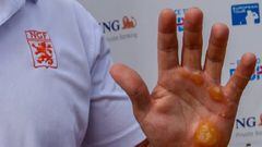 Koen Kouwenaar muestra su mano llena de callos.