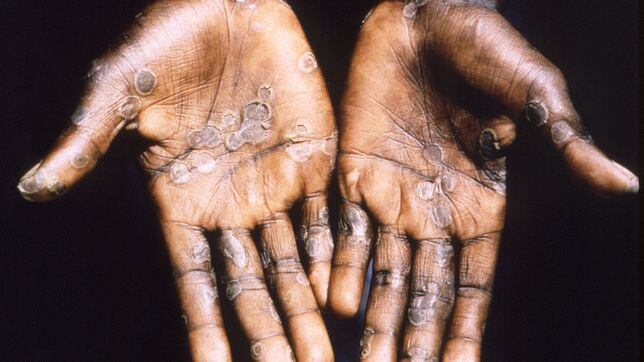 What are the early symptoms of monkeypox?