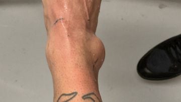 Neymar posts grim photo of ankle injury