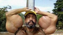 Imagen de Valdir Segato, conocido como el 'Hulk brasileño', posando con sus bíceps en los que inyectó synthol.
