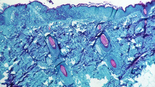 How does monkeypox spread and what are the differences with covid-19?