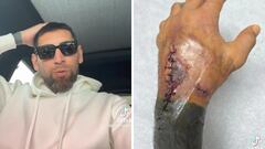 Video: Jonathan Orozco reveló imágenes de la operación que sufrió y se le complicó