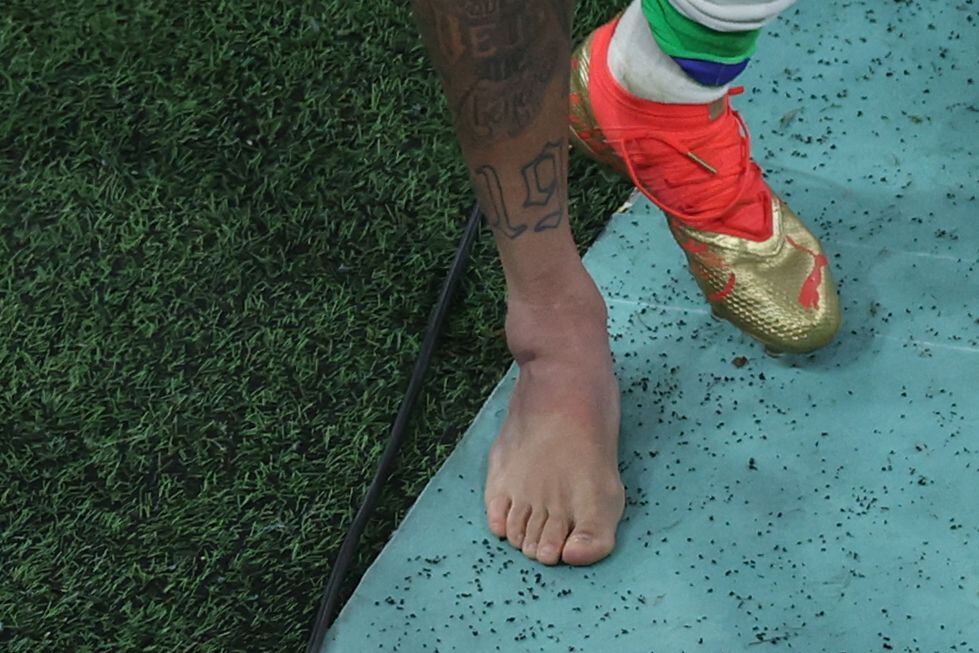 Picture of the swollen ankle of Brazil's forward #10 Neymar 