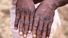 An image created during an investigation into an outbreak of monkeypox, which took place in the Democratic Republic of the Congo (DRC), 1996 to 1997, shows the hands of a patient with a rash due to monkeypox, in this undated image obtained by Reuters on M