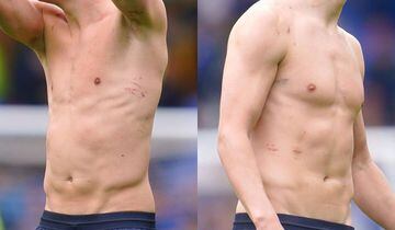 Marks on Erling Haaland's torso after the duel with Yerry Mina.