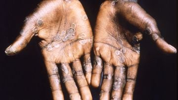 The palms of a monkeypox case patient from Lodja, a city located within the Katako-Kombe Health Zone, are seen during a health investigation in the Democratic Republic of Congo in 1997.