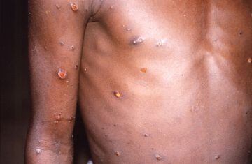 An image created during an investigation into an outbreak of monkeypox, which took place in the Democratic Republic of the Congo, 1996 to 1997, shows the arms and torso of a patient with skin lesions due to monkeypox.