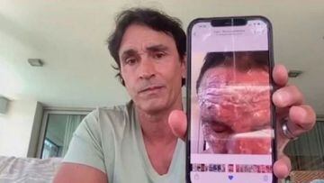 Sebastián Estevanez mostró fotos de su rostro tras el accidente con alcohol para concientizar
