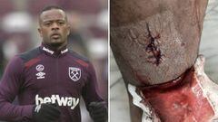 Evra muestra su brutal herida en su debut con el West Ham contra el Liverpool. Foto: redes sociales