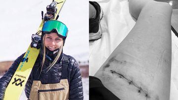 Casi pierde la pierna: dramático relato de esquiadora chilena