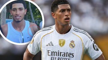 ¡Bellingham ya luce su aparatosa cicatriz!