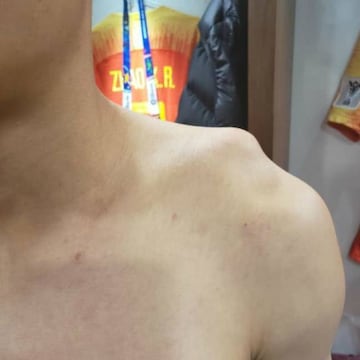 El hombro de Wu Lei después de lesionarse ante Kirguistán