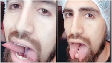 Imágenes sensibles: la impactante cirugía en la cara que se hizo el ex Boca Junior Benítez