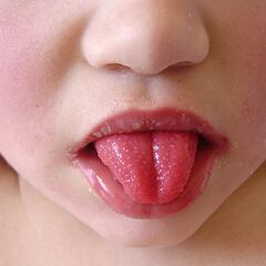 Qué es la escarlatina, enfermedad que aumenta contagios en México: síntomas y cómo se transmite