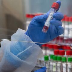 Un estudio vincula la mayor variabilidad de glóbulos rojos con más mortalidad en pacientes COVID