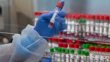 A laboratory technician handles swab samples in the microbiology department, where a high demand in PCR tests has led to intense activity, at the Emile-Muller hospital in Mulhouse, eastern France, on November 17, 2020, amid the Covid-19 (novel coronavirus) pandemic. - The Emile-Muller Hospital had 100 Covid-19 patients on November 17, 18 of whom were in intensive care. A clear increase was felt since the beginning of November, but far from the "wall" encountered during the spring, when a military hospital was built on the parking lot to reach up to 500 Covid beds. (Photo by PATRICK HERTZOG / AFP)