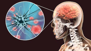 Brote de meningitis en México | Casos confirmados, síntomas y medicamentos