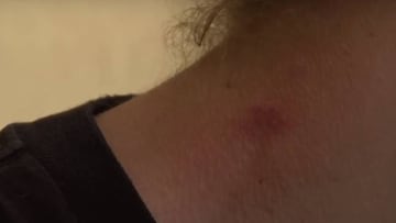 Un menor mexicano murió por un coágulo provocado por el chupetón de su pareja.