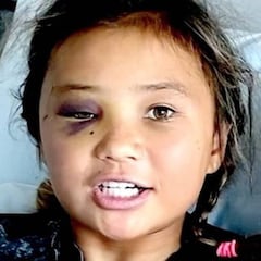 La skater 'influencer' de 11 años se fractura la cabeza y otros huesos en una terrorífica caída