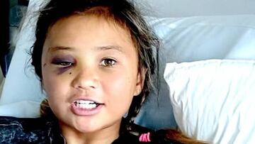 Sky Brown, el prodigio del skate de Gran Bretaña, sufrió la peor caída de su vida en un Vert de California y lo subió a Instagram. Así le quedó la cara.