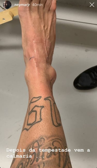Neymar posts grim photo of ankle injury