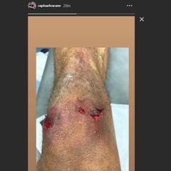 Varane muestra cómo quedó su rodilla tras el segundo gol