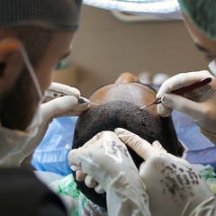 Los efectos secundarios de un trasplante capilar