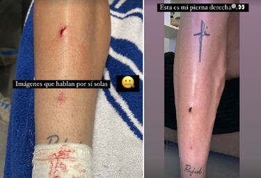 As¨ª qued¨® la pierna de Rafa Mar¨ªn: ¡°Im¨¢genes que hablan por s¨ª solas¡±