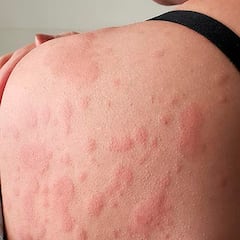 Qué es la urticaria por calor, el motivo por el que sufrimos picores por el sudor en verano