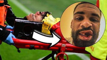 Así ha quedado la mandíbula de Loftus-Cheek tras su escalofriante choque 