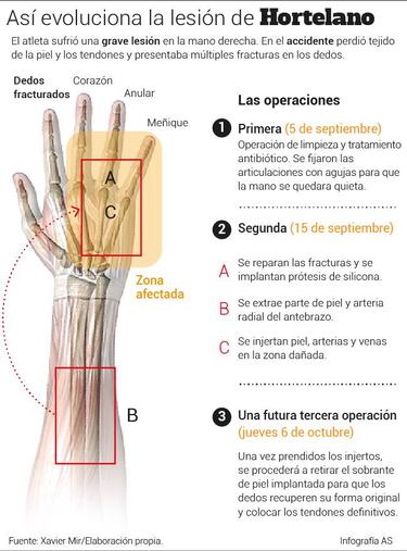 El doctor Mir: "Bruno Hortelano es un paciente espectacular"