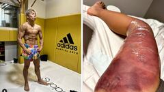 El luchador japonés de kickboxing Takeru Segawa muestra cómo quedó su pierna tras su combate ante Superlek Kiatmuu9 en ONE Championship.
